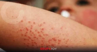 Hidalgo reporta contagios del virus Coxsackie en la región Tula–Tepeji