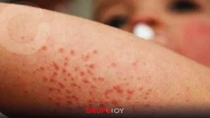 Hidalgo reporta contagios del virus Coxsackie en la región Tula–Tepeji