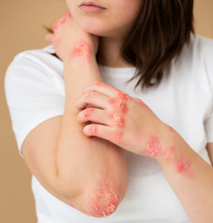 virus coxsackie en Hidalgo