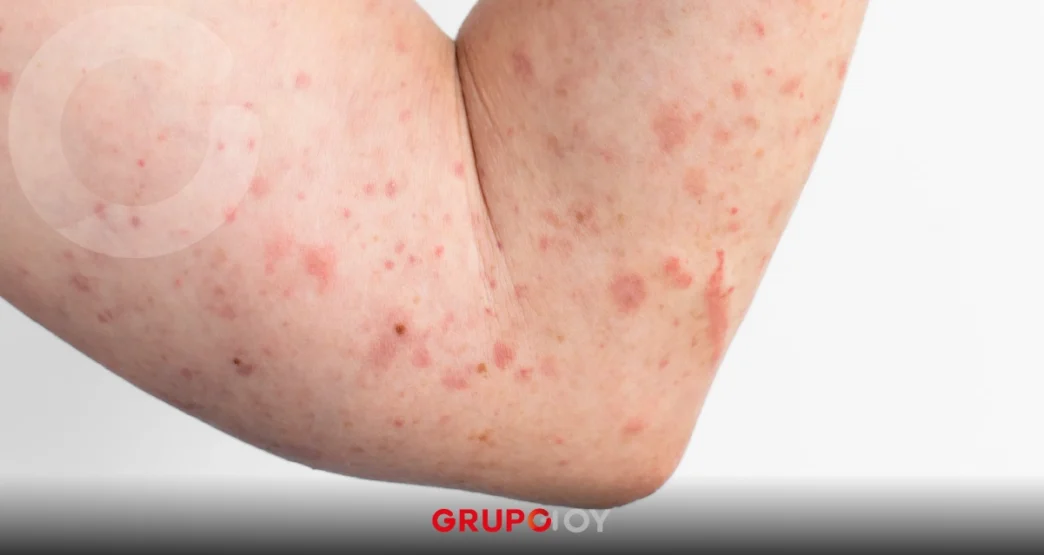 sarampión en Chiapas