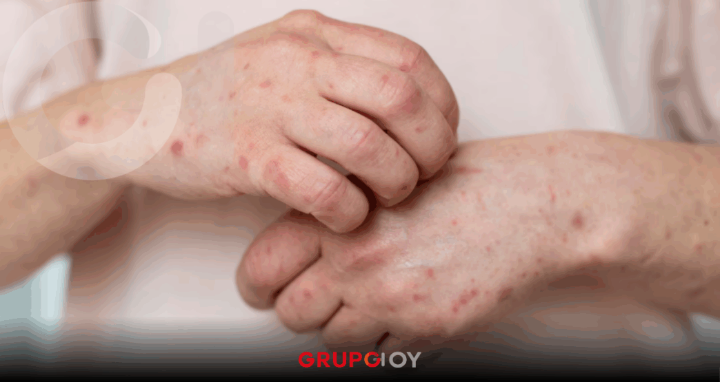 casos de sarampión en Hidalgo