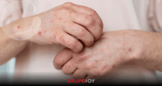 casos de sarampión en Hidalgo