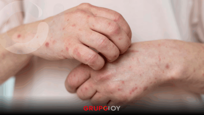 casos de sarampión en Hidalgo