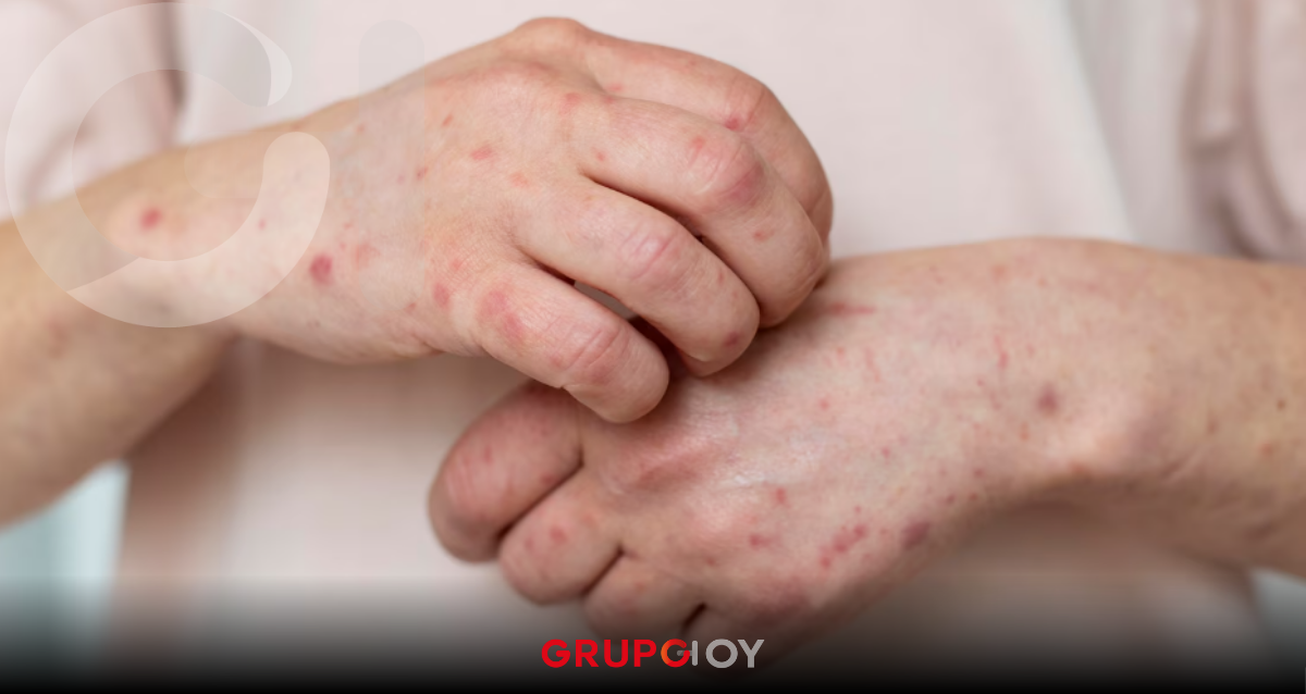 casos de sarampión en Hidalgo