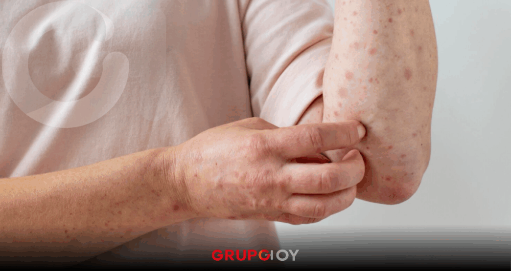 Sarampión en México 2026