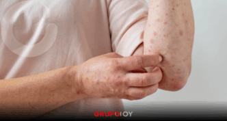 Sarampión en México 2026