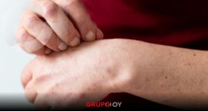 Sarampión en México: más de 8,000 casos confirmados y 27 fallecimientos