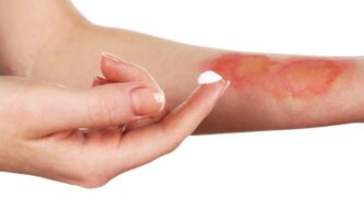 ¿Cuándo y dónde serán las jornadas quirúrgicas gratuitas para paladar hendido y quemaduras en Nuevo León?