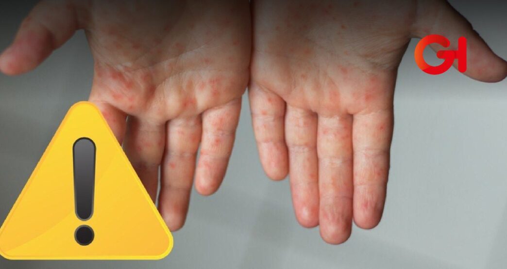 Alerta sanitaria por brote del virus Coxsackie en Tecaltzingo, Puebla