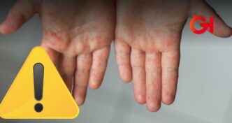 Alerta sanitaria por brote del virus Coxsackie en Tecaltzingo, Puebla
