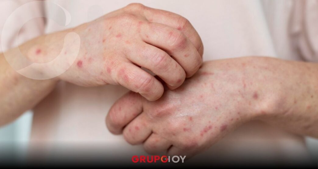 Secretaría de Salud confirman primer caso de sarampión en Puebla