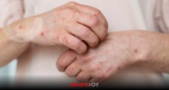 Secretaría de Salud confirman primer caso de sarampión en Puebla