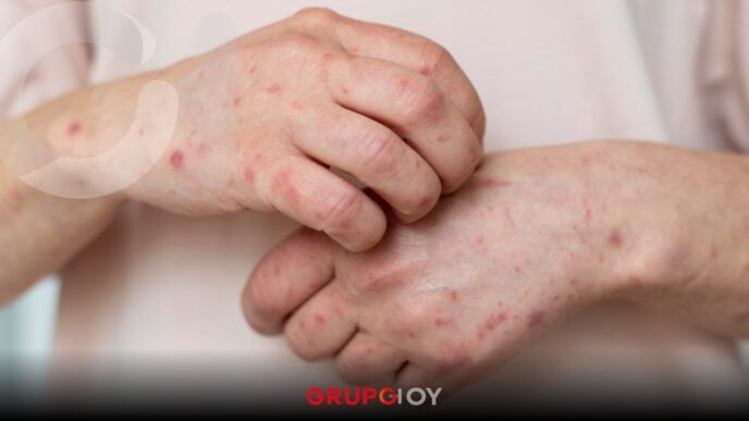 Secretaría de Salud confirman primer caso de sarampión en Puebla