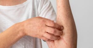 Sarampión en Tlaxcala: autoridades confirman 28 casos en enero y febrero de 2026