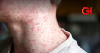 Aumentan casos de sarampión en México: CONAVE emite alerta epidemiológica