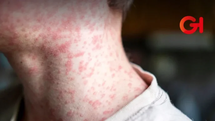 Aumentan casos de sarampión en México: CONAVE emite alerta epidemiológica