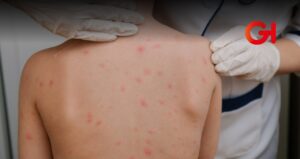 Hay 2 mil 942 casos de sarampión en México: Secretaría de Salud