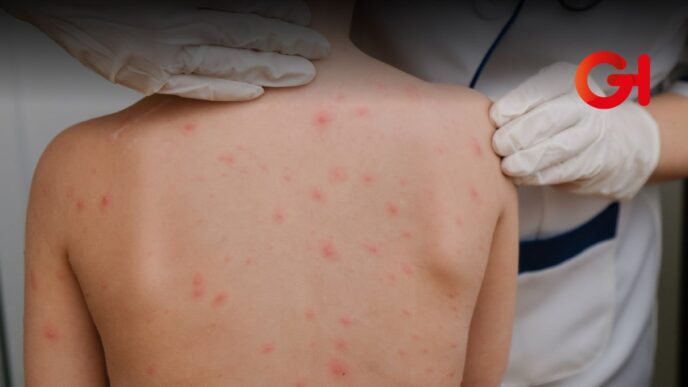 Hay 2 mil 942 casos de sarampión en México: Secretaría de Salud